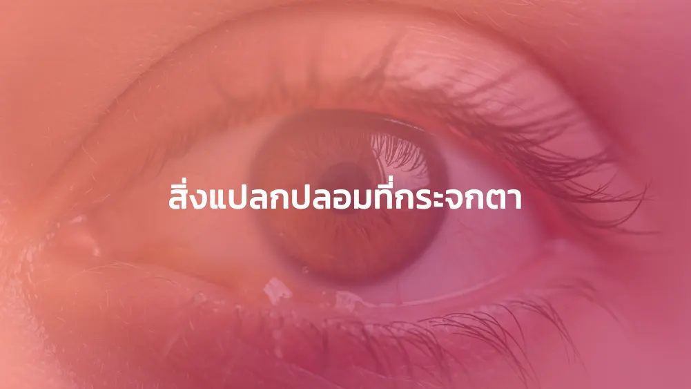 สิ่งแปลกปลอมที่กระจกตา