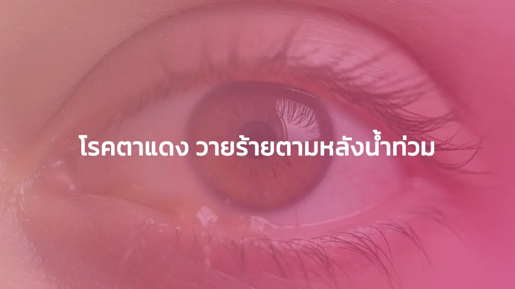 โรคตาแดง วายร้ายตามหลังน้ำท่วม