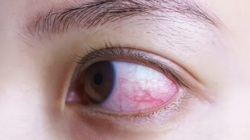 ตาแดงกี่วันหาย