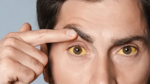 ตาขาวเหลืองเกิดจากอะไร อาการแบบไหนควรพบแพทย์