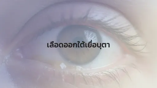 เลือดออกใต้เยื่อบุตา