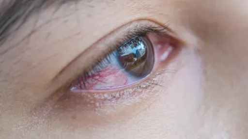 เส้นเลือดฝอยในตาแตก อันตรายหรือไม่