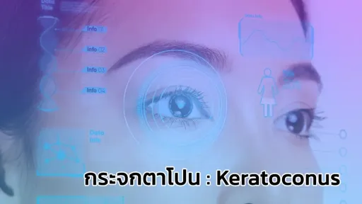 กระจกตาโปน : Keratoconus