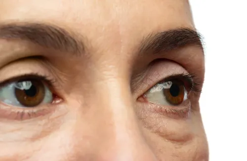 จอประสาทตาเสื่อม อาการเริ่มต้นเป็นอย่างไร