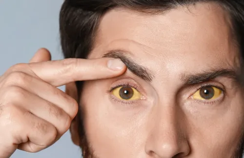 ตาขาวเหลืองเกิดจากอะไร อาการแบบไหนควรพบแพทย์