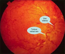 จอประสาทตา