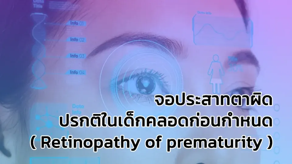 จอประสาทตาผิดปรกติในเด็กคลอดก่อนกำหนด ( Retinopathy of prematurity )