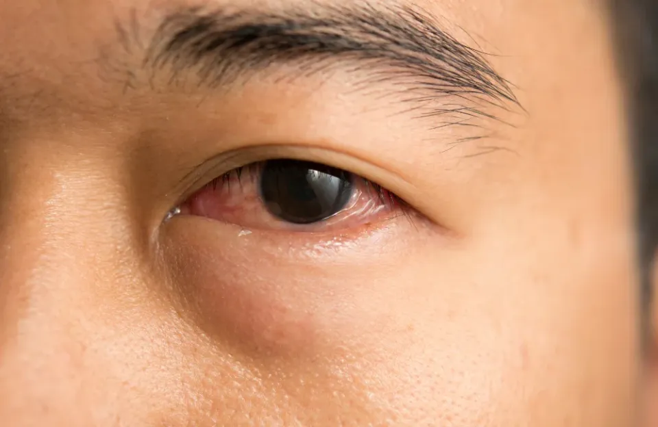 ตาแดงเกิดจากสาเหตุใด