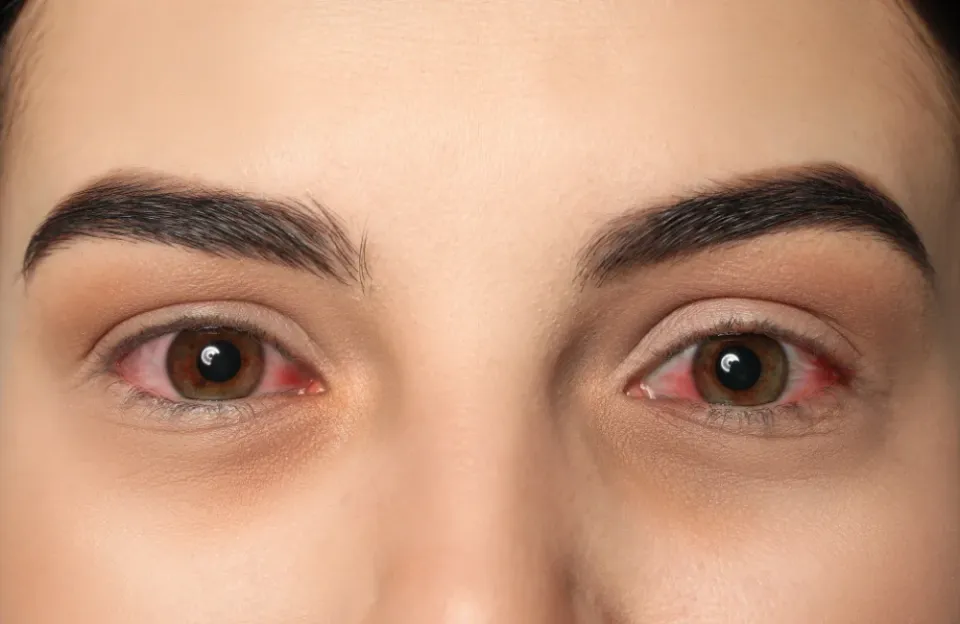 ตาแดงติดต่อกันทางไหนได้บ้าง