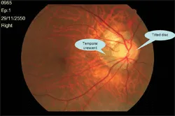 จอประสาทตา