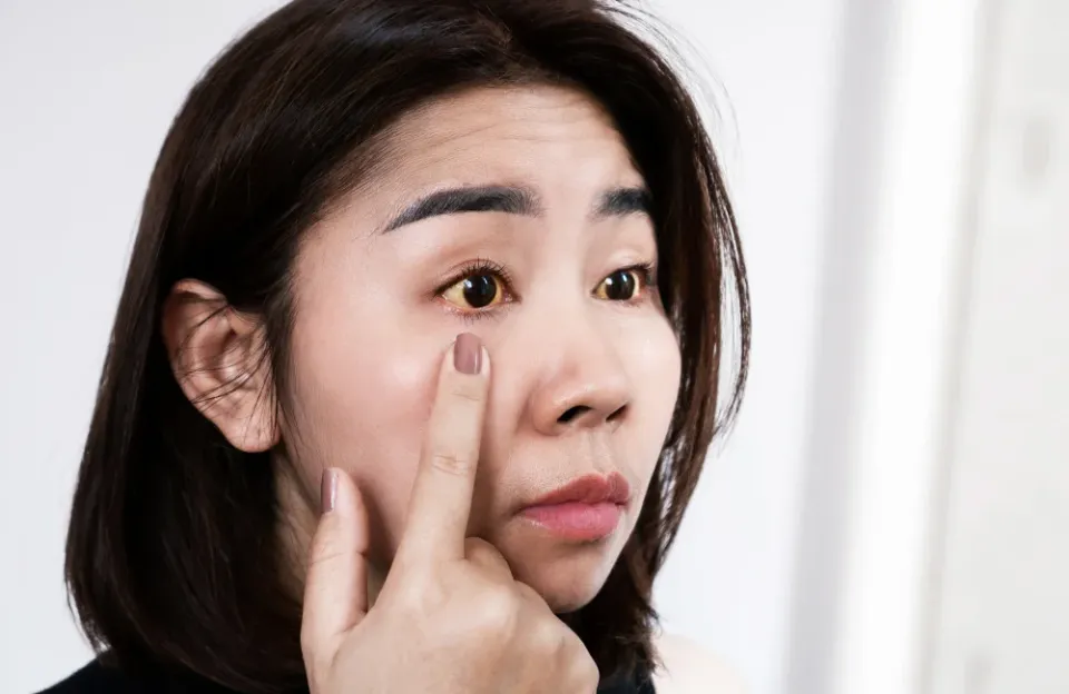 วิธีดูแลดวงตา ป้องกันอาการตาขาวเหลือง