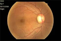 จอประสาทตา