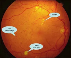 จอประสาทตา