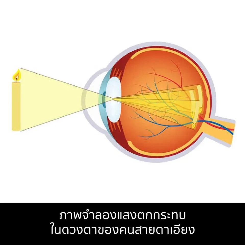 สายตาเอียง (Astigmatism)